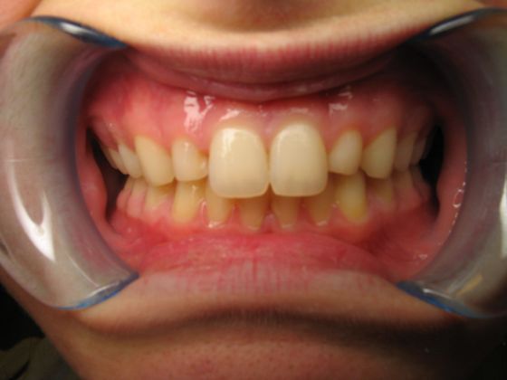 Gum Contouring Laser "smile-lift" - Before