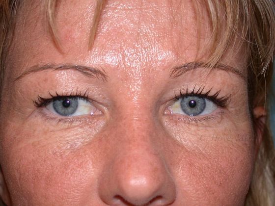 Eyelids (Blepharoplasty) Case 1- Upper Eyelid Blepharoplasty (Dr Christopher Hove, Philadelphia