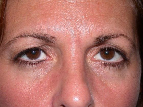 Eyelids (Blepharoplasty) Case 2- Upper Eyelid Blepharoplasty (Dr Christopher Hove, Philadelphia