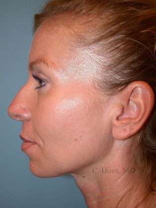 Nose Reshaping (Rhinoplasty) Case 1- Cosmetic Rhinoplasty (Dr Christopher Hove, Philadelphia