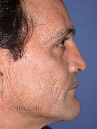Nose Reshaping (Rhinoplasty) Case 2- Reconstructive Rhinoplasty (Dr Christopher Hove, Philadelphia