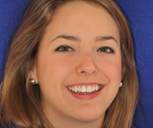 Veneers: Case 25 - Before