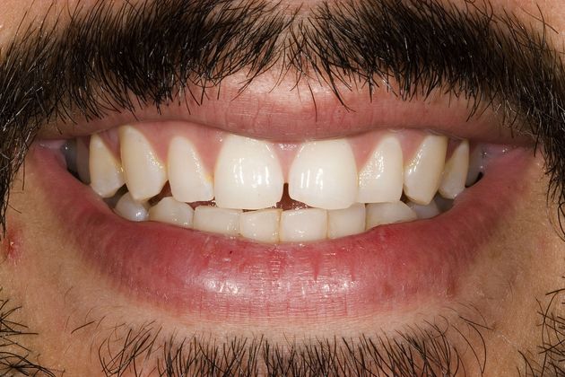 Veneers Case 26 - Before