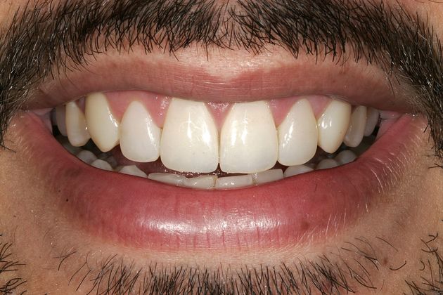 Veneers Case 26 - After