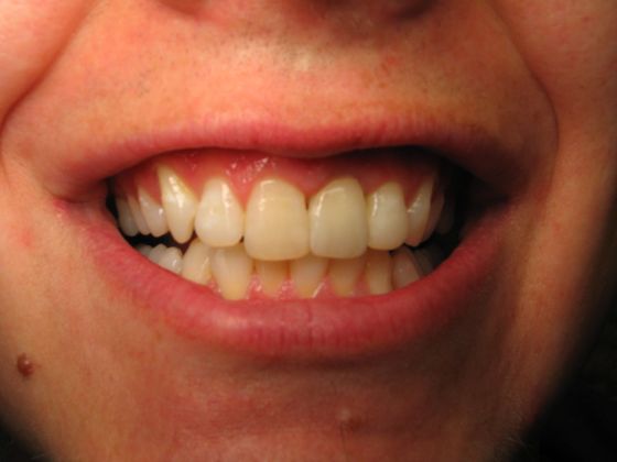 Dental Implants Case 2 - After