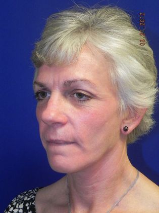 Facial Facelift / Necklift: Case 17 (15220) - After