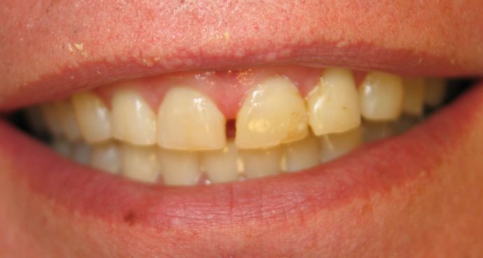 Porcelain Veneers: Patient #5 - Porcelain Veneers Before