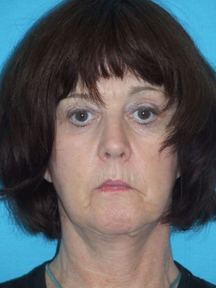 Mini Facelift Case 3 - Before