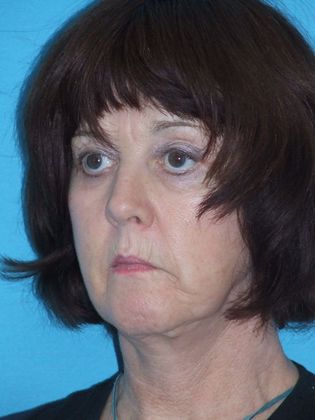 Mini Facelift: Case 3 - Before