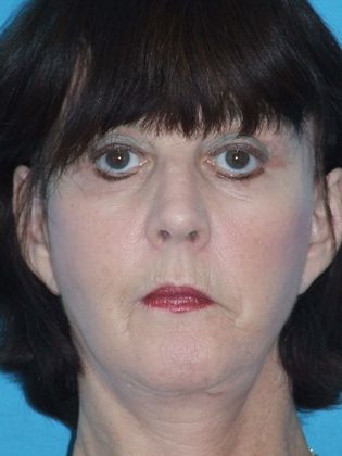 Mini Facelift Case 3 - After