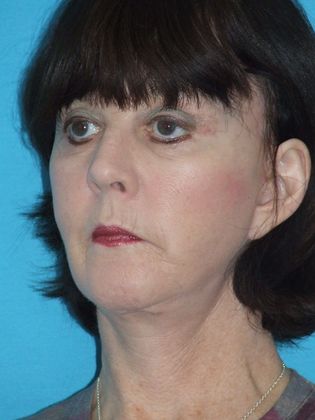 Mini Facelift: Case 3 - After