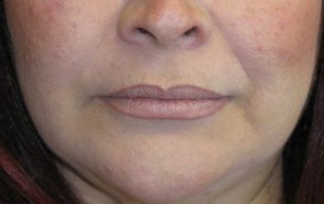 Lip Implants: Case 1 - Before