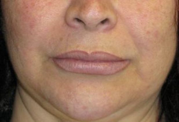 Lip Implants: Case 1 - After 2 months