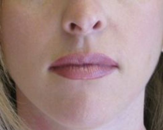 Lip Implants: Case 2 - Before