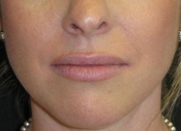 Lip Implants: Case 2 - After one year