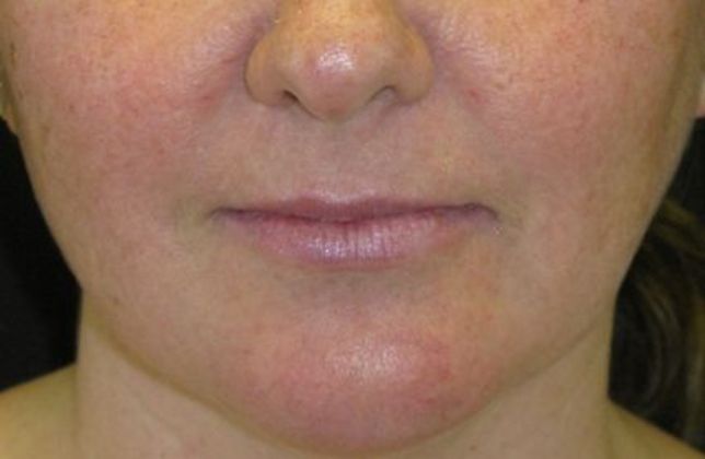 Lip Implants: Case 3 - Before