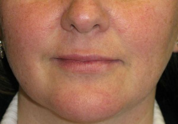 Lip Implants: Case 3 - After 5 months