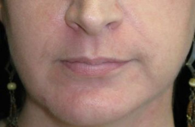 Lip Implants Case 4 - Before