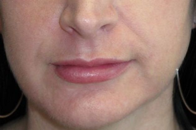 Lip Implants Case 4 - After