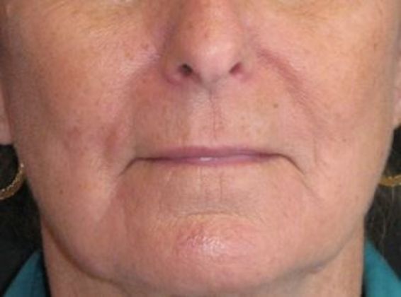 Lip Implants: Case 5 - Before