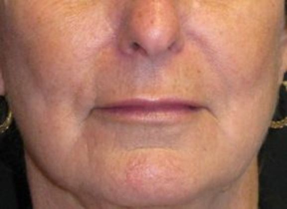 Lip Implants: Case 5 - After 1 month