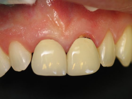 Porcelain Veneers: Patient #6 - Porcelain Veneers and Porcelain Crowns Before