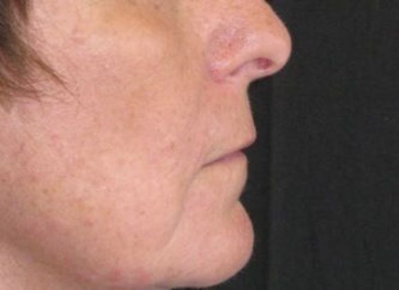 Lip Implants: Case 5 - before