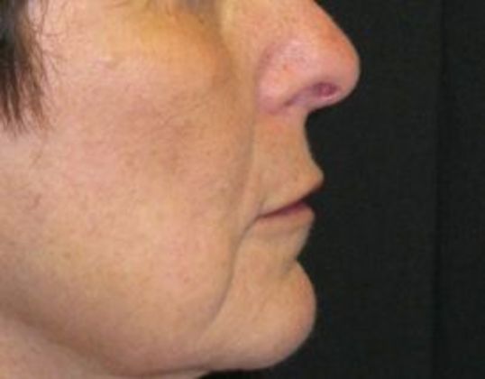 Lip Implants: Case 5 - after 1 month