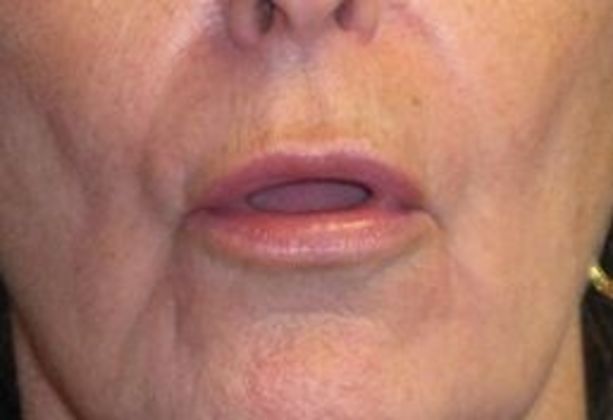 Lip Implants: Case 5 - after 1 month with lips pursed