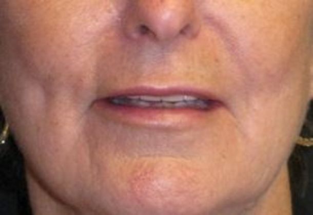 Lip Implants: Case 5 - after one month with smile