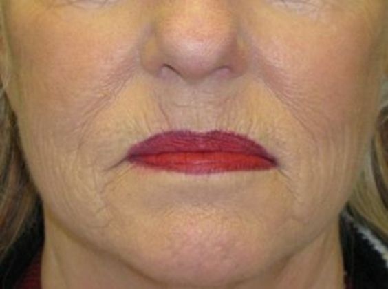 Lip Implants: Case 6 - before