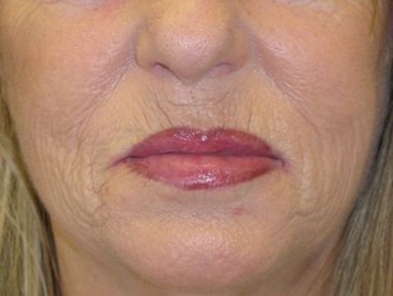 Lip Implants: Case 6 - after 4 months