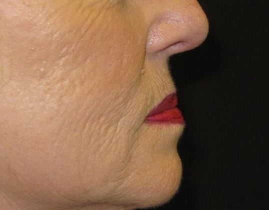 Lip Implants: Case 6 - before