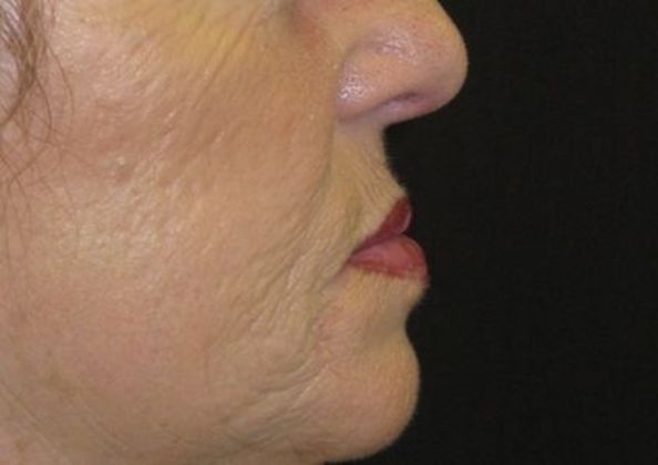 Lip Implants: Case 6 - after 4 months