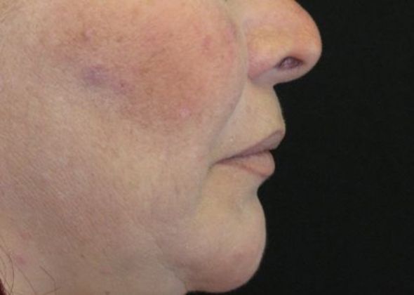 Lip Implants: Case 1 - before