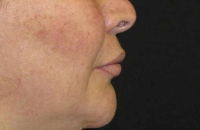 Lip Implants: Case 1 - after 2 months