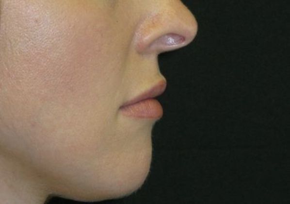 Lip Implants: Case 2 - before