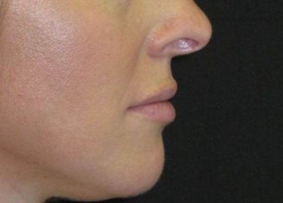 Lip Implants: Case 2 - after 1 year