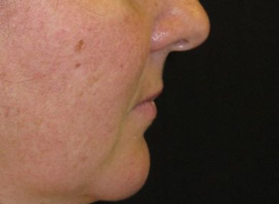 Lip Implants: Case 3 - before