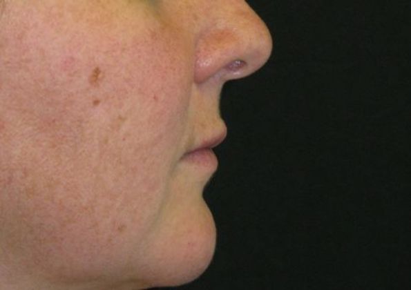 Lip Implants: Case 3 - after 5 months