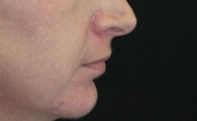 Lip Implants: Case 4 - before