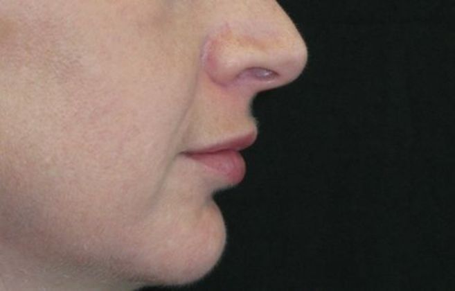 Lip Implants: Case 4 - after 1 month