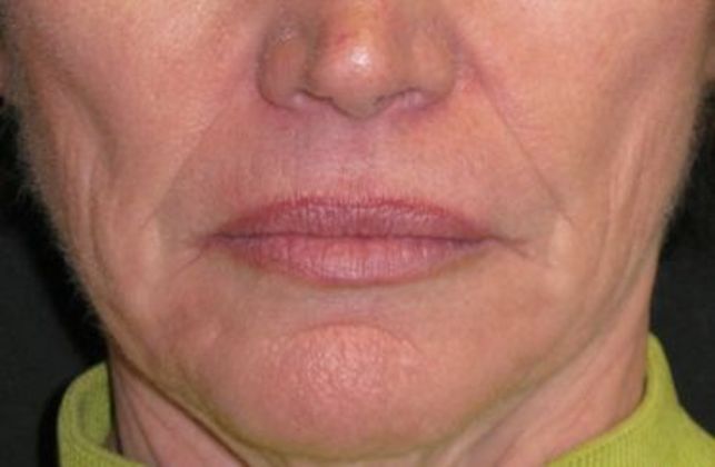 Lip Implants Case 7 - Before