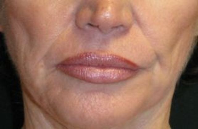 Lip Implants Case 7 - After