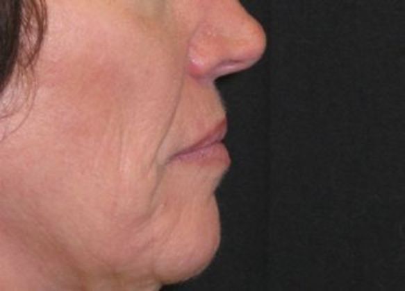 Lip Implants: Case 7 - before