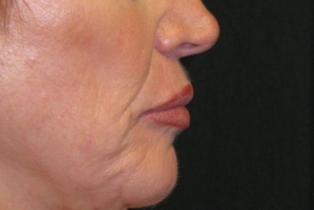 Lip Implants: Case 7 - after 6 months