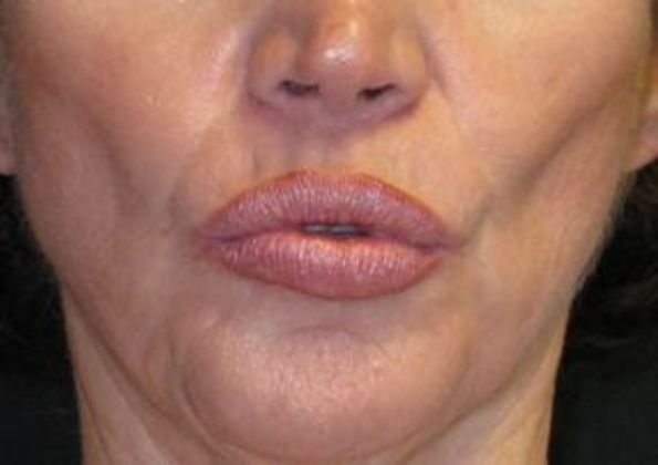 Lip Implants: Case 7 - after 6 months lips pursed
