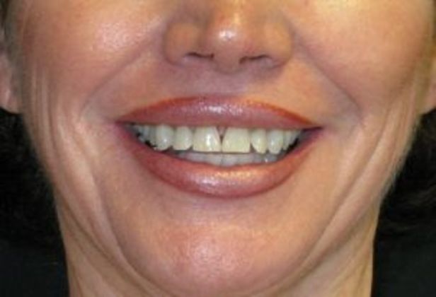 Lip Implants: Case 7 - after 6 months with smile