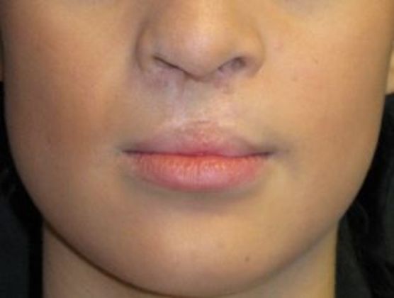 Lip Implants: Case 8 - before