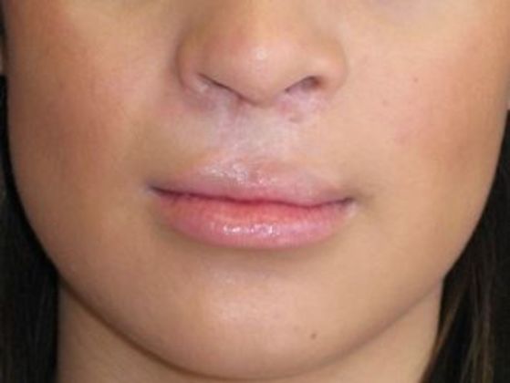 Lip Implants: Case 8 - after 1 month